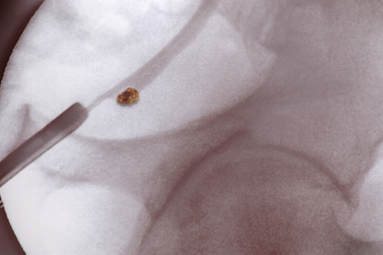 A vesekő tünetei és kezelése