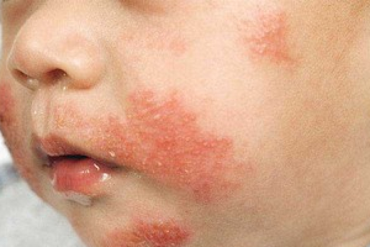 Lassabban nőnek az ételallergiás gyerekek